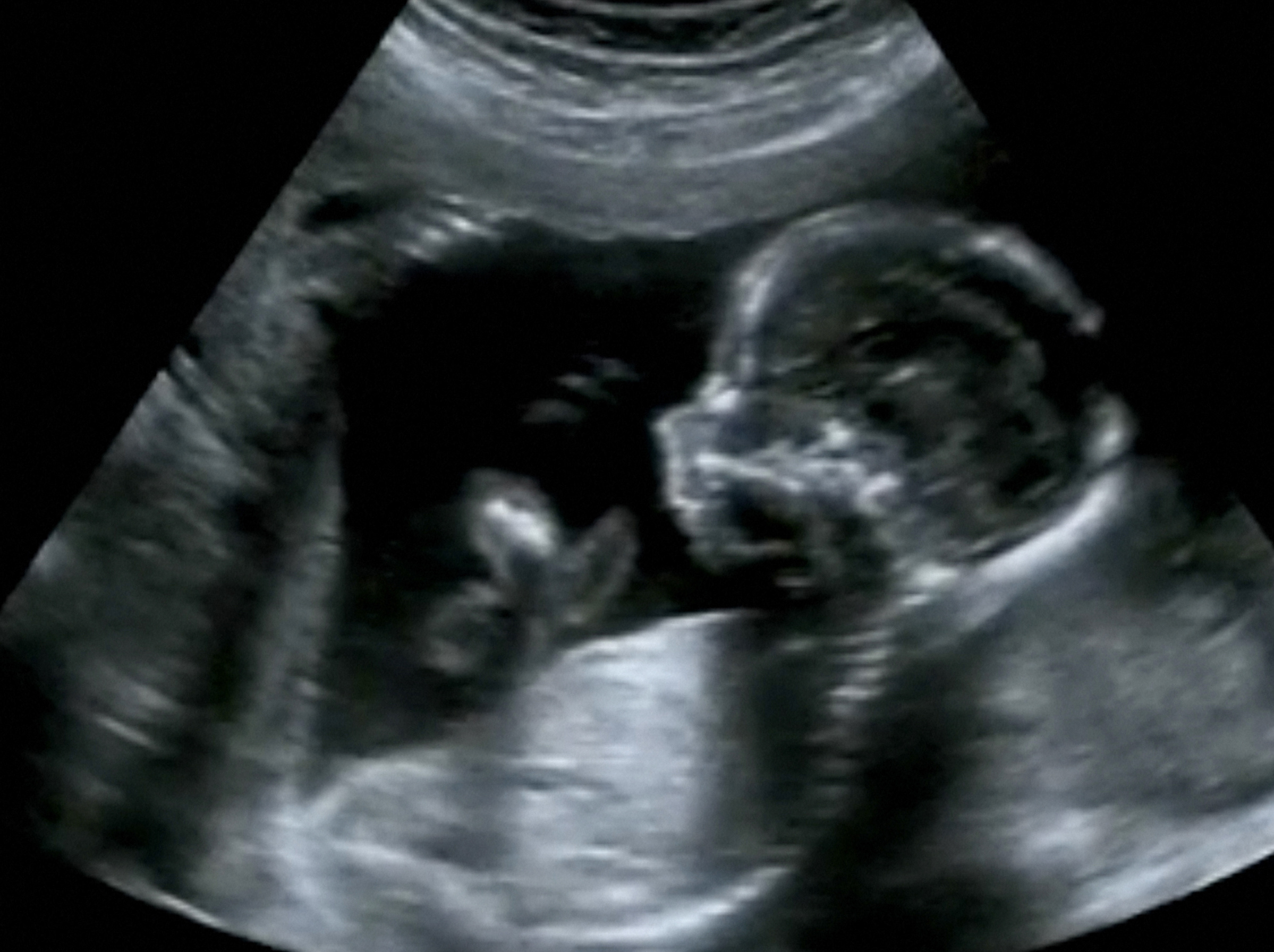 pictures-collage-ultrasonography-fetus-scan-stock-photo-my-xxx-hot-girl